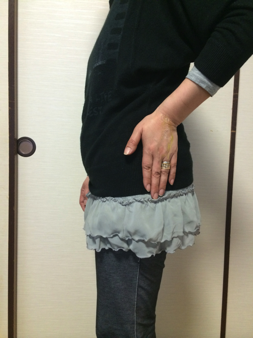 広島-腰や下腹部の違和感や痛みを放っておいたら歩けなくなった-腰痛改善事例6