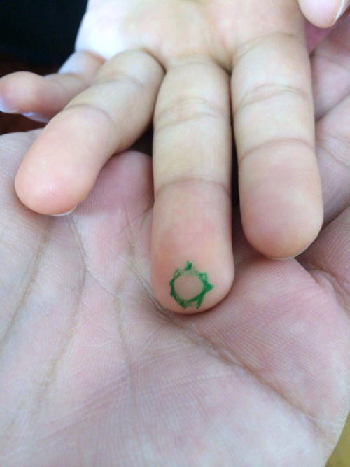 子どもの花粉症の鼻水をとめて頭痛を解消するおまじない7