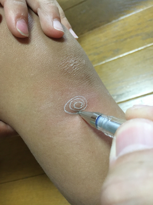 虫刺されの痒みと晴れを一発解消するおまじない4