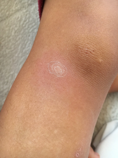 虫刺されの痒みと晴れを一発解消するおまじない2