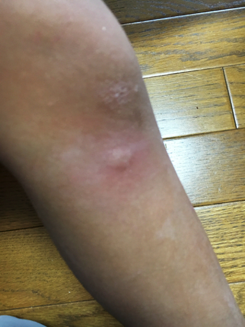 虫刺されの痒みと晴れを一発解消するおまじない3